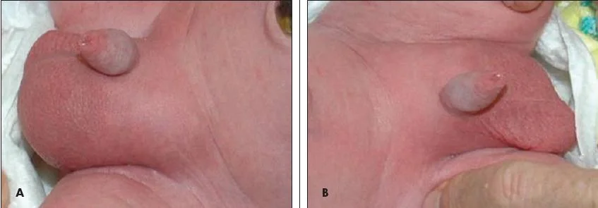 الفتق الاربي عند الرضع, congenital inguinal hernia, الفتاق, فتق أربي, عملية الفتاق, اعراض الفتاق, فتق, عرض,بطن, الفتق عند الاطفال فى الخصيه, عملية الفتق الاربي للرضع, ما بعد عملية الفتق الاربي عند الاطفال, الفتق الاربي عند البنات, inguinal hernia, عيادة الاطفال, دكتور اطفال, د.يوسف قضا, طب الاطفال, امراض الاطفال, اطفال